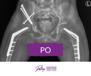 Podwichnięcie w stawie biodrowym po operacji