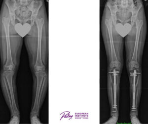 Wydłużanie kończyn gwoździami drugie zdjęcie